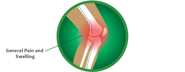 knee-arthritis