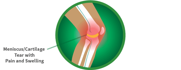 running-knee-meniscus-cartilage-tear